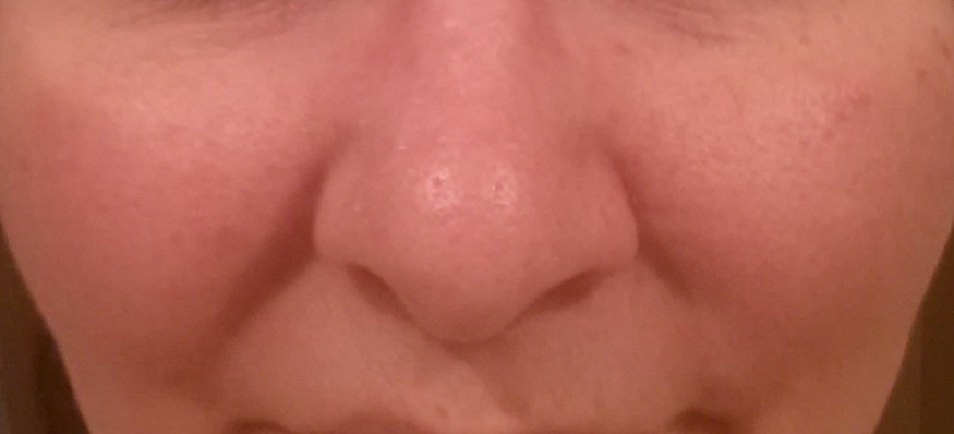 close look at the contact dermatitis around my nose