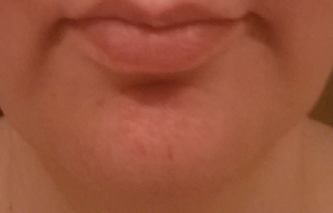 mild case of contact dermatitis around my chin