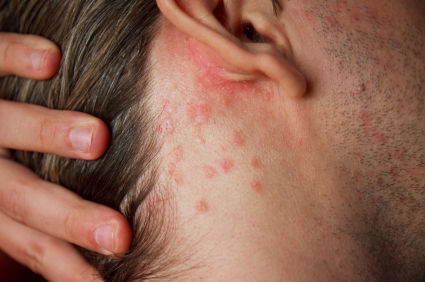 how contact dermatitis can present